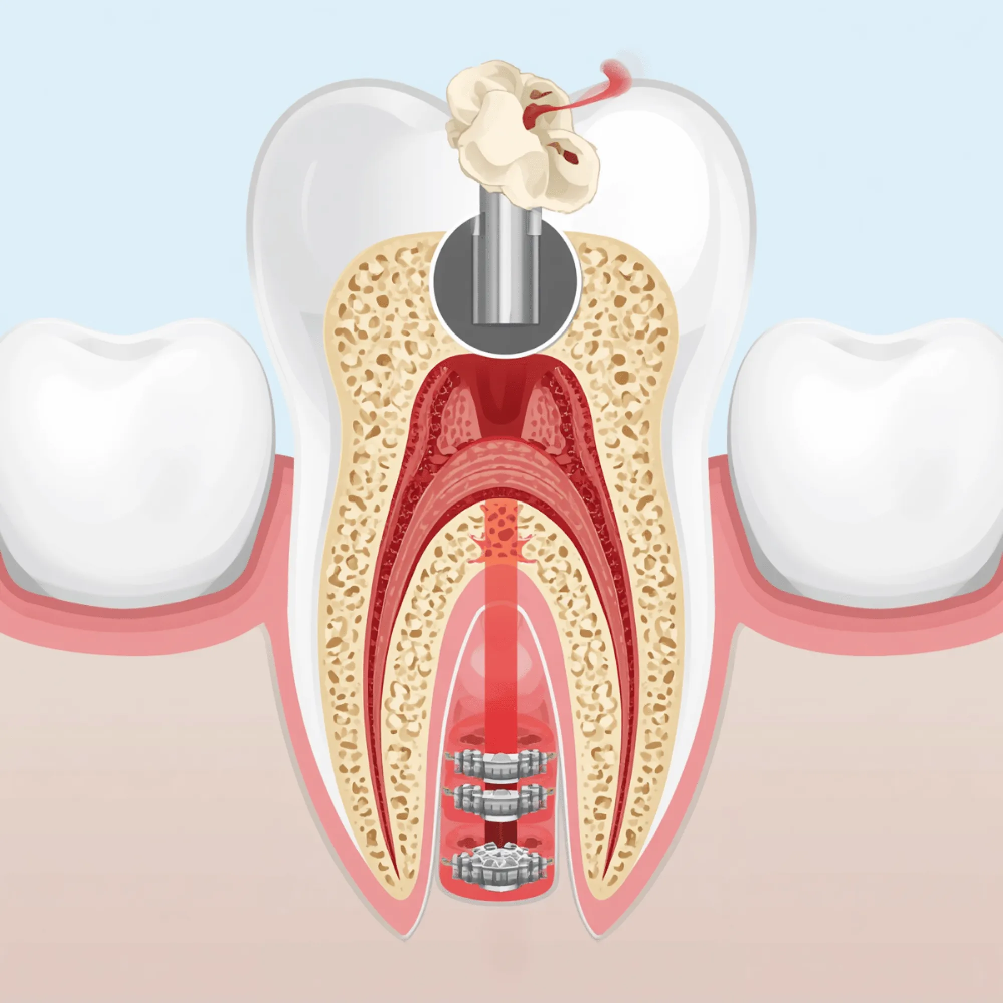 Inflamed gums from a trapped popcorn kernel under the gumline